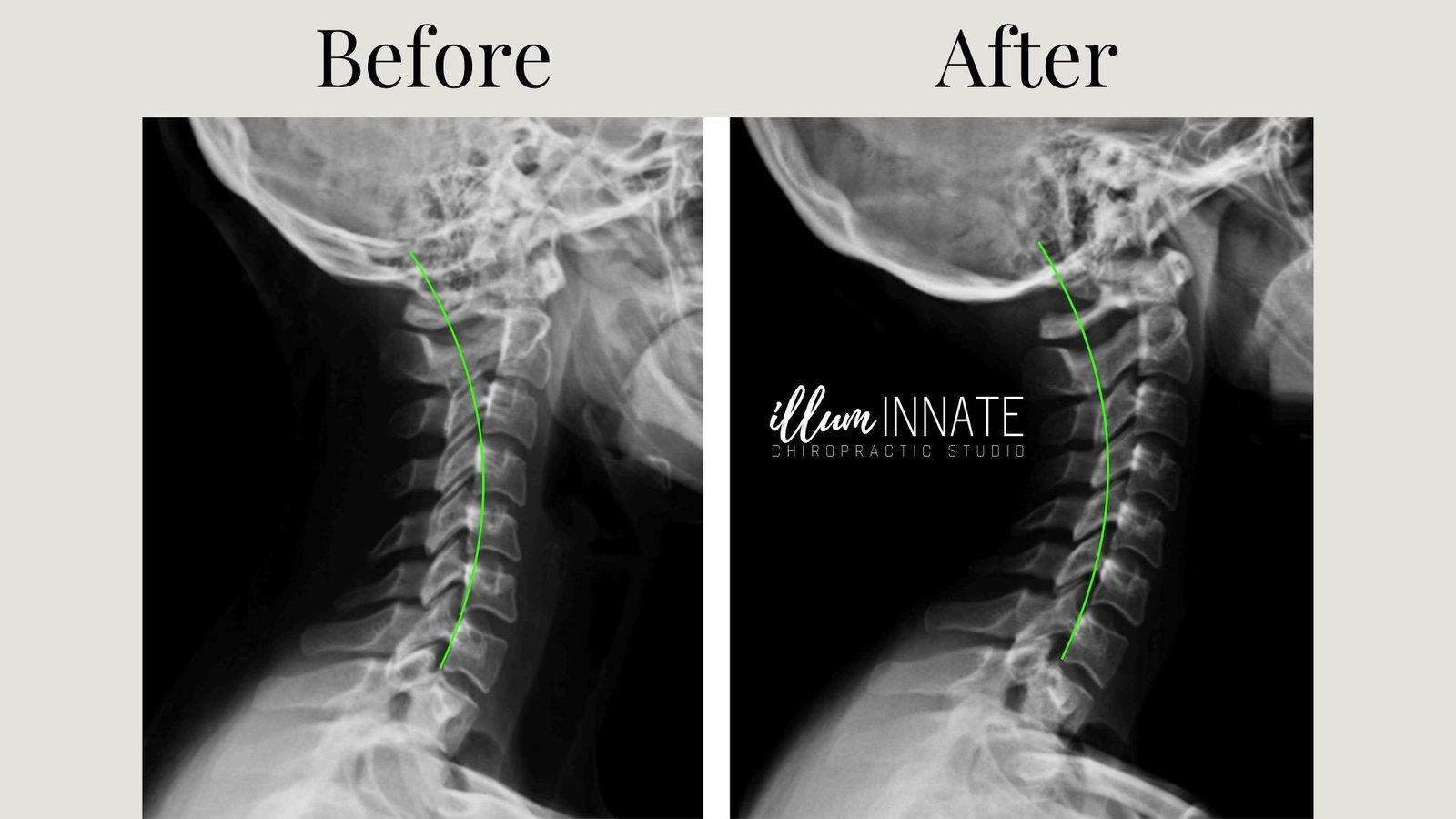 Can Chiropractic Help Correct Cervical Lordosis?